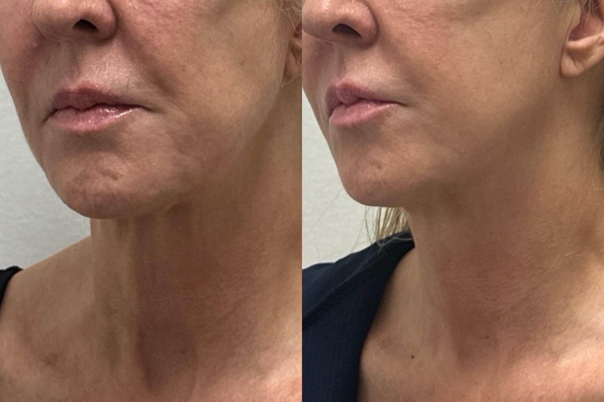 Nowak Aesthetics morpheus8 result — Chula Vista, CA