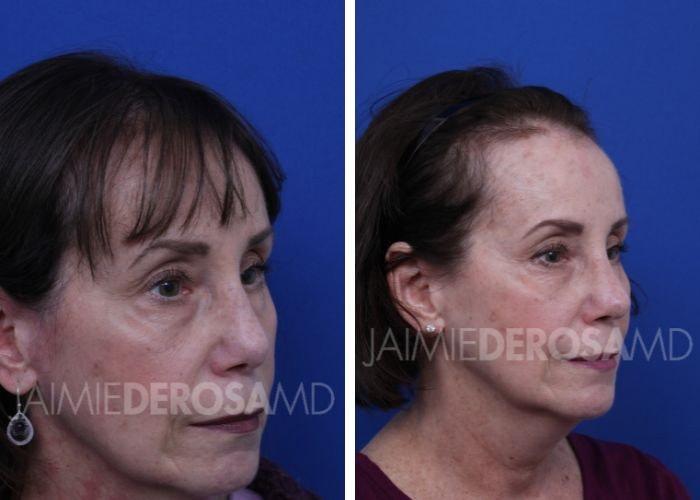 The DeRosa Center for Plastic Surgery – Palm Beach rhinoplasty result — Palm Beach, FL
