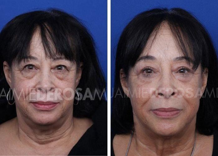 The DeRosa Center for Plastic Surgery – Palm Beach facelift result — Palm Beach, FL