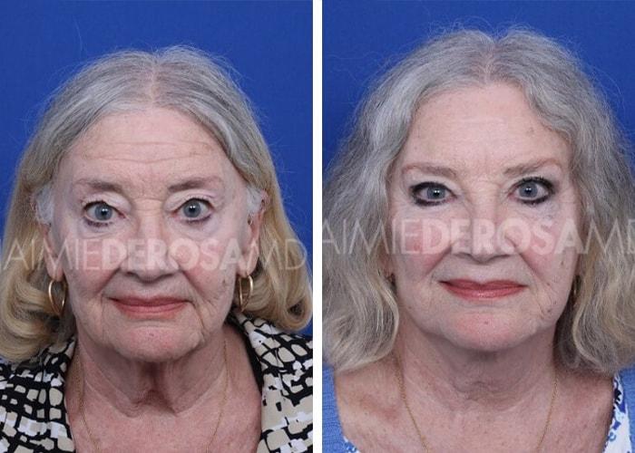 The DeRosa Center for Plastic Surgery – Palm Beach facelift result — Palm Beach, FL