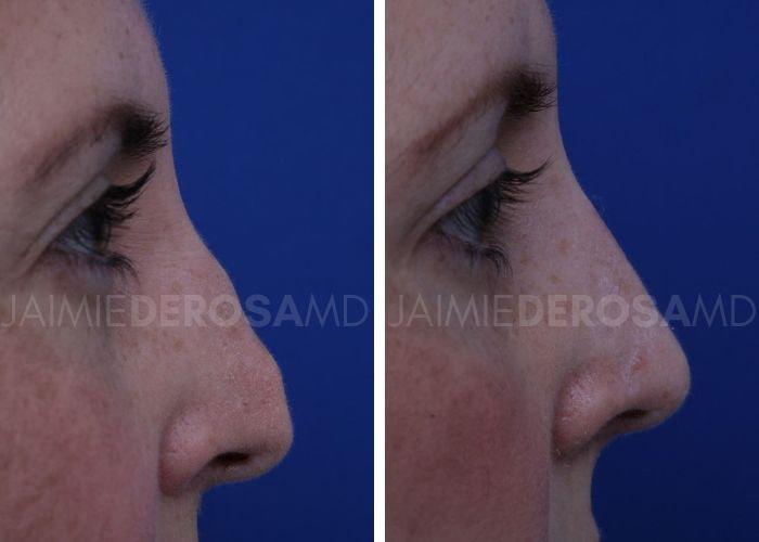 The DeRosa Center for Plastic Surgery – Palm Beach rhinoplasty result — Palm Beach, FL