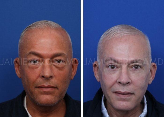 The DeRosa Center for Plastic Surgery – Palm Beach blepharoplasty result — Palm Beach, FL
