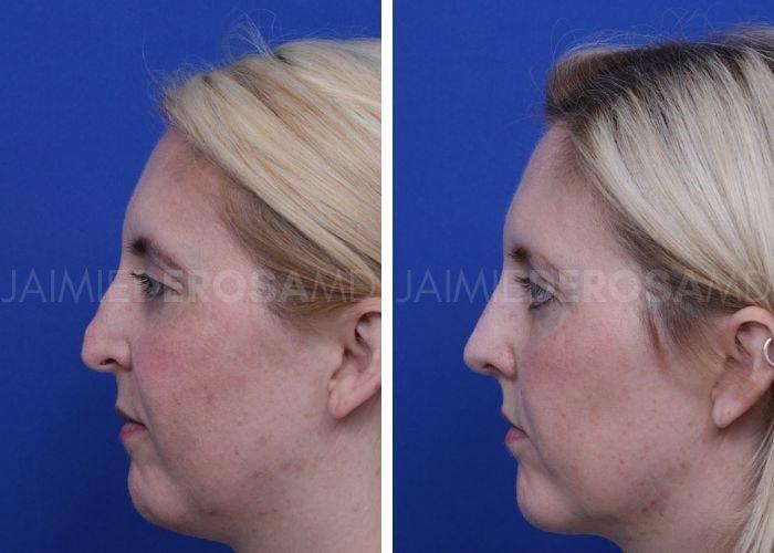 The DeRosa Center for Plastic Surgery – Palm Beach rhinoplasty result — Palm Beach, FL