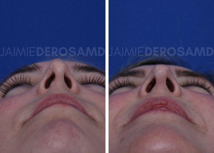 The DeRosa Center for Plastic Surgery – Palm Beach rhinoplasty result — Palm Beach, FL