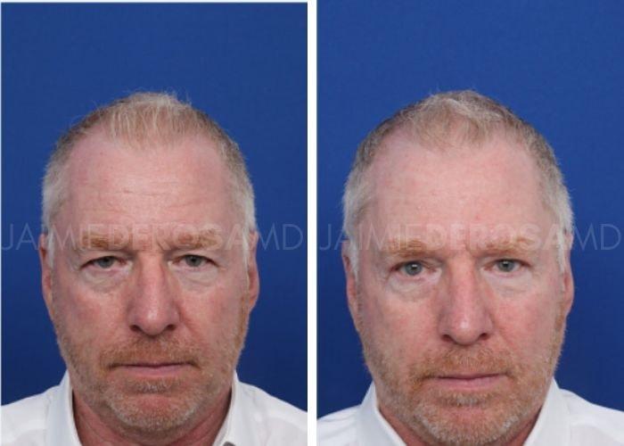 The DeRosa Center for Plastic Surgery – Palm Beach blepharoplasty result — Palm Beach, FL