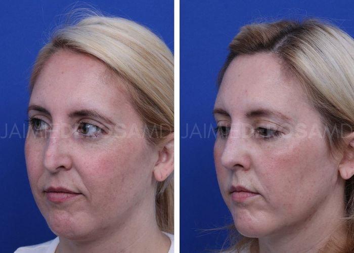 The DeRosa Center for Plastic Surgery – Palm Beach rhinoplasty result — Palm Beach, FL
