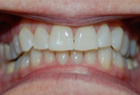 Berry Farms Dental smile makeover after — Franklin, TN