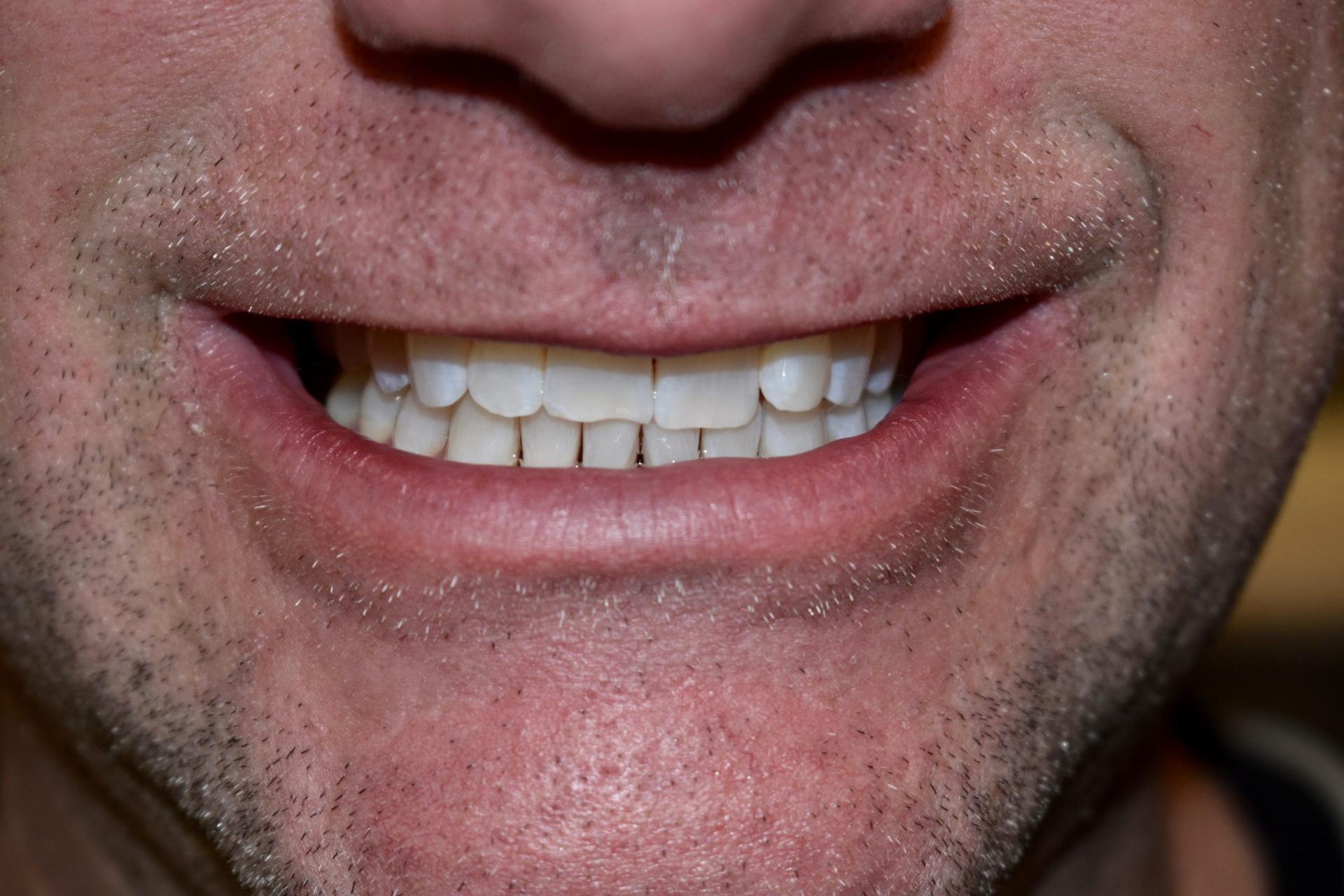 Berry Farms Dental smile makeover after — Franklin, TN