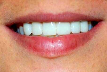 Berry Farms Dental smile makeover after — Franklin, TN