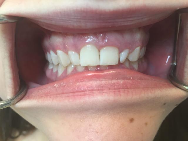 Smile Makeover before at Berry Farms Dental in Franklin, TN
