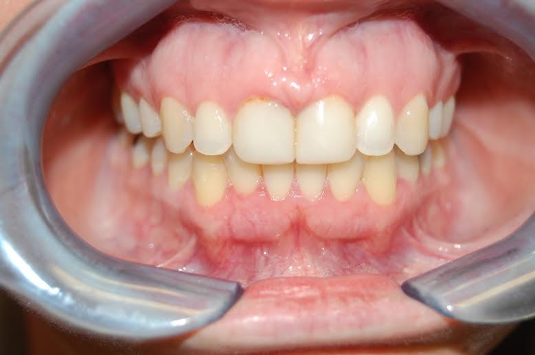 Berry Farms Dental invisalign after — Franklin, TN