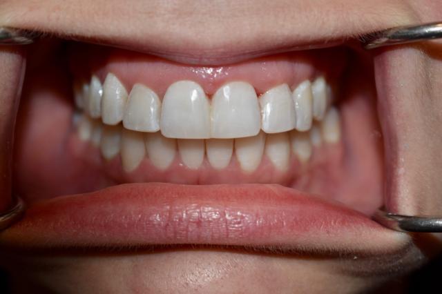 Invisalign after at Berry Farms Dental in Franklin, TN