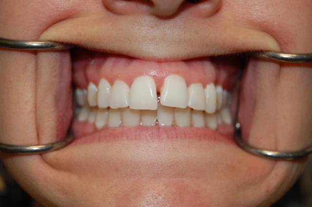 Invisalign before at Berry Farms Dental in Franklin, TN