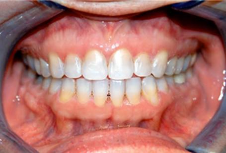 Berry Farms Dental smile makeover after — Franklin, TN