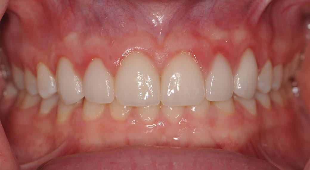 Berry Farms Dental smile makeover after — Franklin, TN