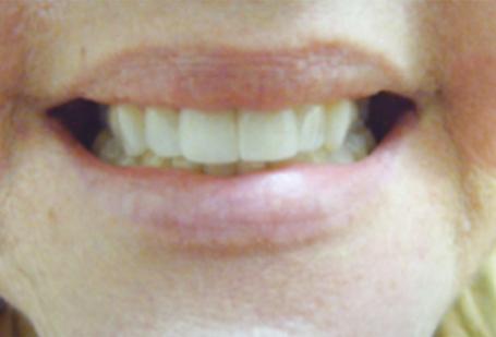 Berry Farms Dental smile makeover after — Franklin, TN