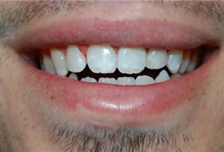 Berry Farms Dental smile makeover after — Franklin, TN