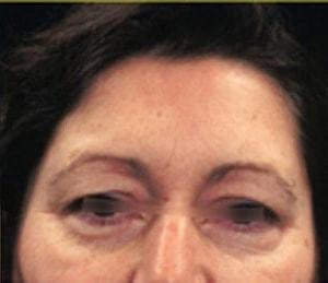 Laurie A. Casas, MD, FACS eyelid lift after — Glenview, IL