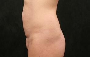 Laurie A. Casas, MD, FACS tummy tuck after — Glenview, IL