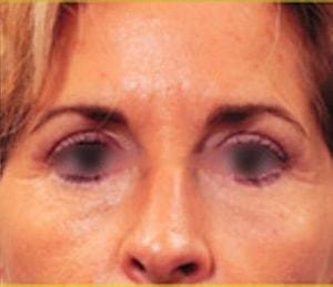 Laurie A. Casas, MD, FACS eyelid lift after — Glenview, IL