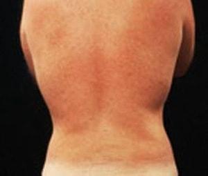 Laurie A. Casas, MD, FACS liposuction after — Glenview, IL