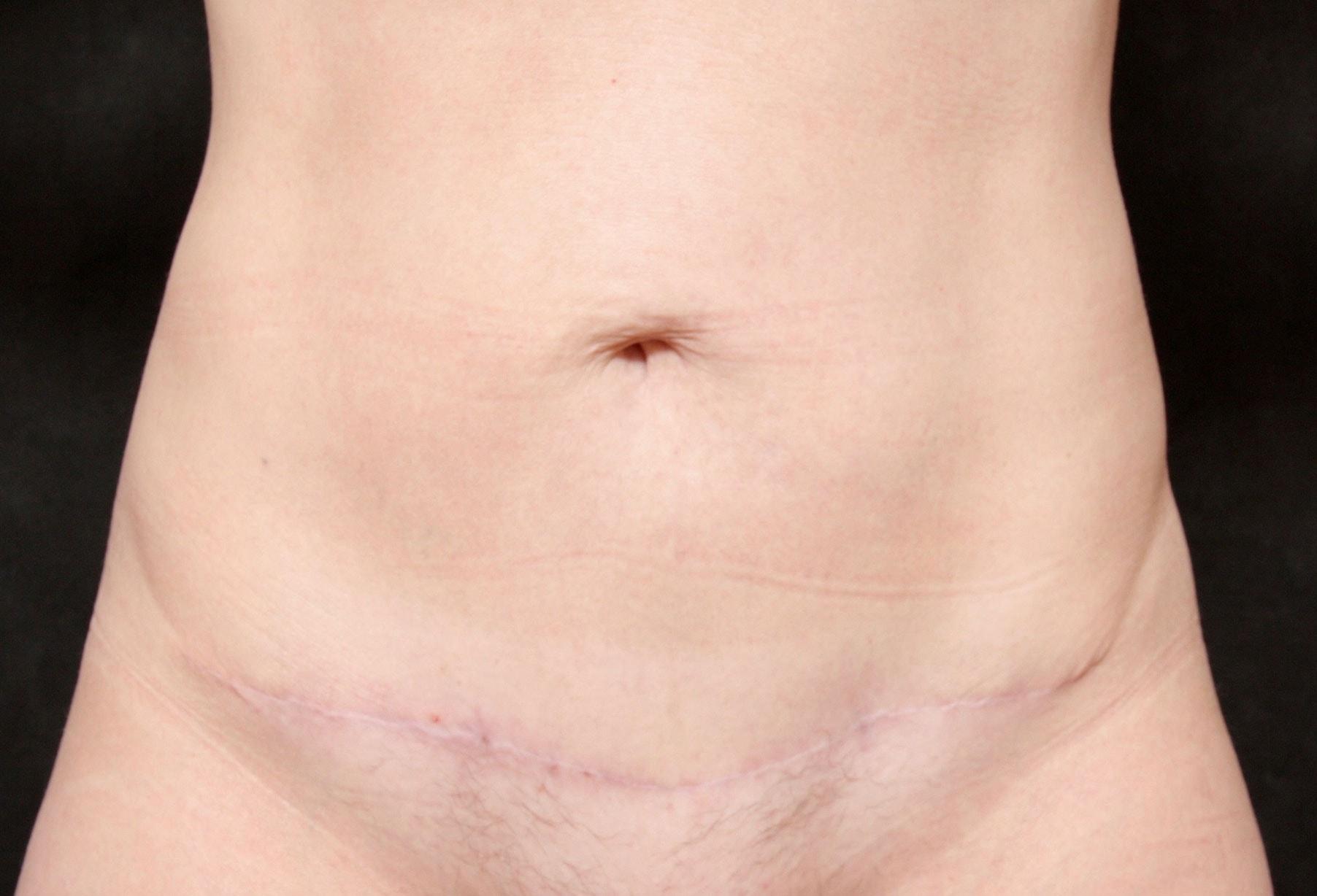 Laurie A. Casas, MD, FACS tummy tuck after — Glenview, IL