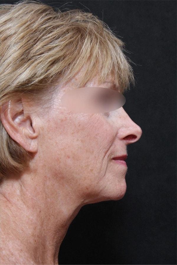 Laurie A. Casas, MD, FACS facelift after — Glenview, IL