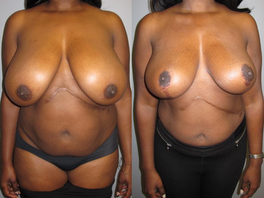 Mytien Goldberg, MD breast reduction result — Beverly Hills, CA