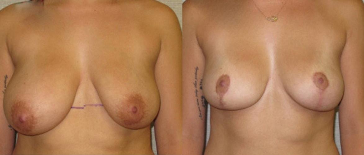Mytien Goldberg, MD breast lift result — Beverly Hills, CA