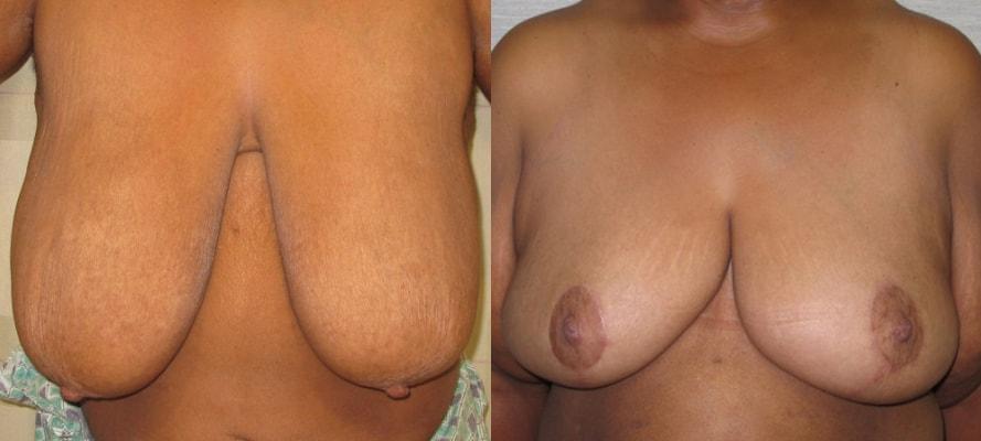 Mytien Goldberg, MD breast reduction result — Beverly Hills, CA