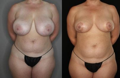 Mytien Goldberg, MD breast reduction result — Beverly Hills, CA
