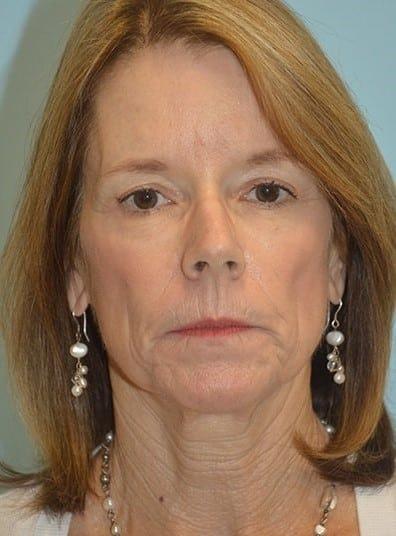 Maloney Center For Facial Plastic Surgery eyelid lift after — Atlanta, GA
