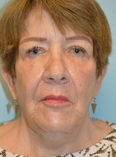 Maloney Center For Facial Plastic Surgery eyelid lift after — Atlanta, GA