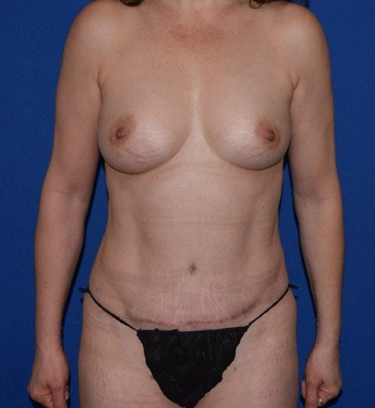 Karol Gutowski, MD mommy makeover after — Glenview, IL