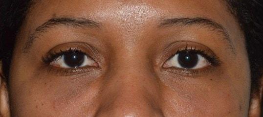 Karol Gutowski, MD under-eye filler after — Glenview, IL