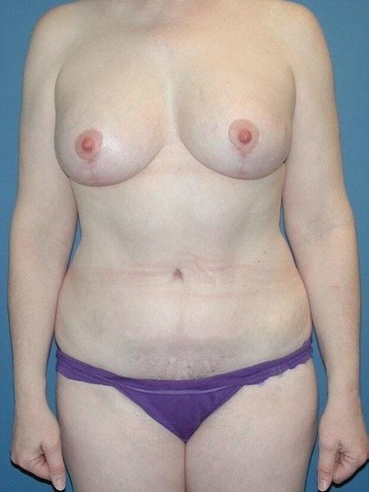 Karol Gutowski, MD mommy makeover after — Glenview, IL