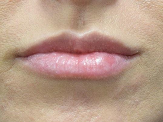 Karol Gutowski, MD lip filler after — Glenview, IL