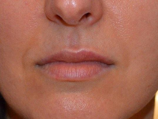 Karol Gutowski, MD lip filler after — Glenview, IL