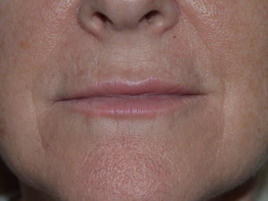 Karol Gutowski, MD lip filler after — Glenview, IL
