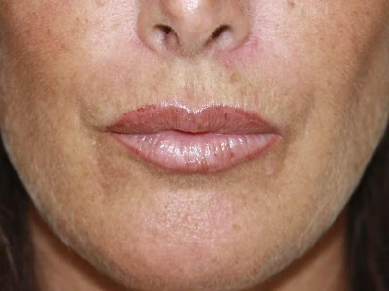 Palm Beach Facial Plastic Surgery lip filler after — Palm Beach Gardens, FL