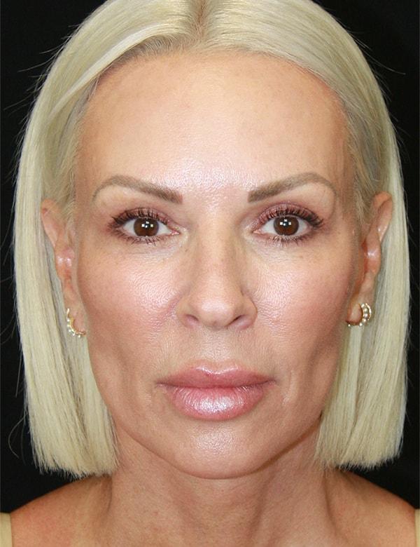 Palm Beach Facial Plastic Surgery facelift after — Palm Beach Gardens, FL