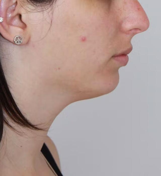Chin Implant before at Palm Beach Facial Plastic Surgery in Palm Beach Gardens, FL