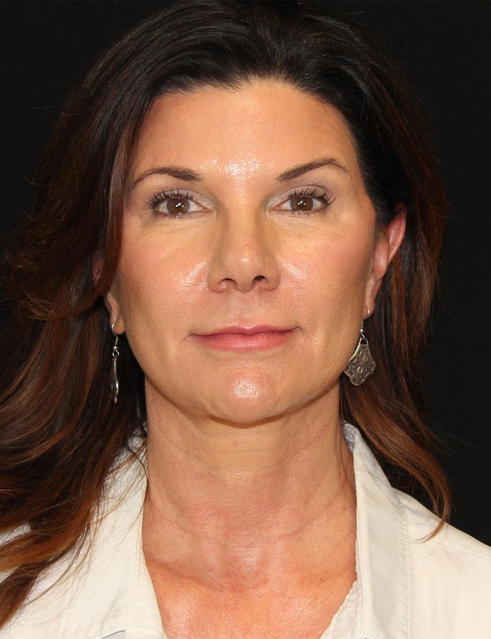 Palm Beach Facial Plastic Surgery facelift after — Palm Beach Gardens, FL