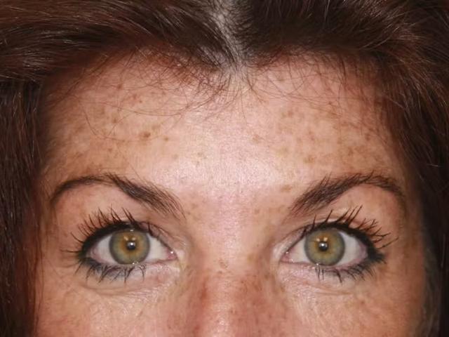 Botox after at Palm Beach Facial Plastic Surgery in Palm Beach Gardens, FL
