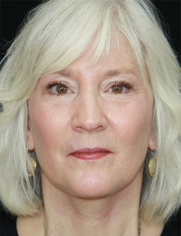 Palm Beach Facial Plastic Surgery facelift after — Palm Beach Gardens, FL