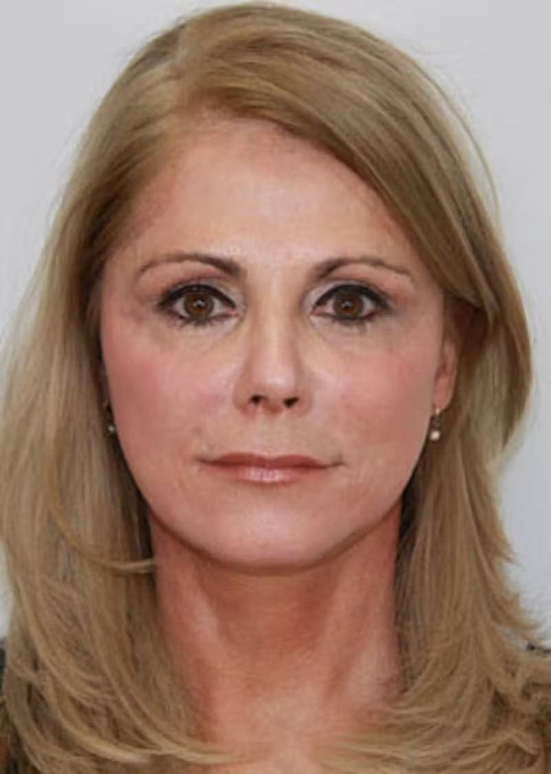 Palm Beach Facial Plastic Surgery fat transfer after — Palm Beach Gardens, FL