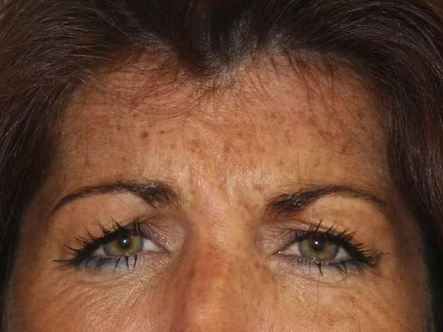 Botox before at Palm Beach Facial Plastic Surgery in Palm Beach Gardens, FL