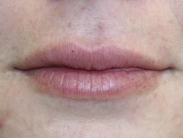 Lip Filler before at Palm Beach Facial Plastic Surgery in Palm Beach Gardens, FL