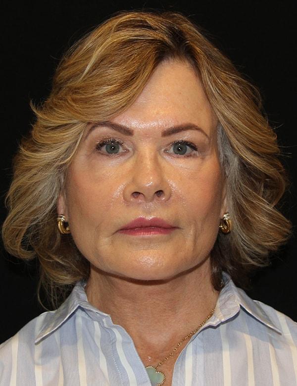 Palm Beach Facial Plastic Surgery facelift after — Palm Beach Gardens, FL