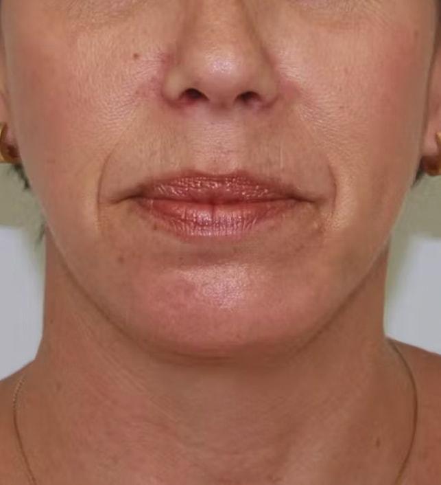 Palm Beach Facial Plastic Surgery chin implant after — Palm Beach Gardens, FL